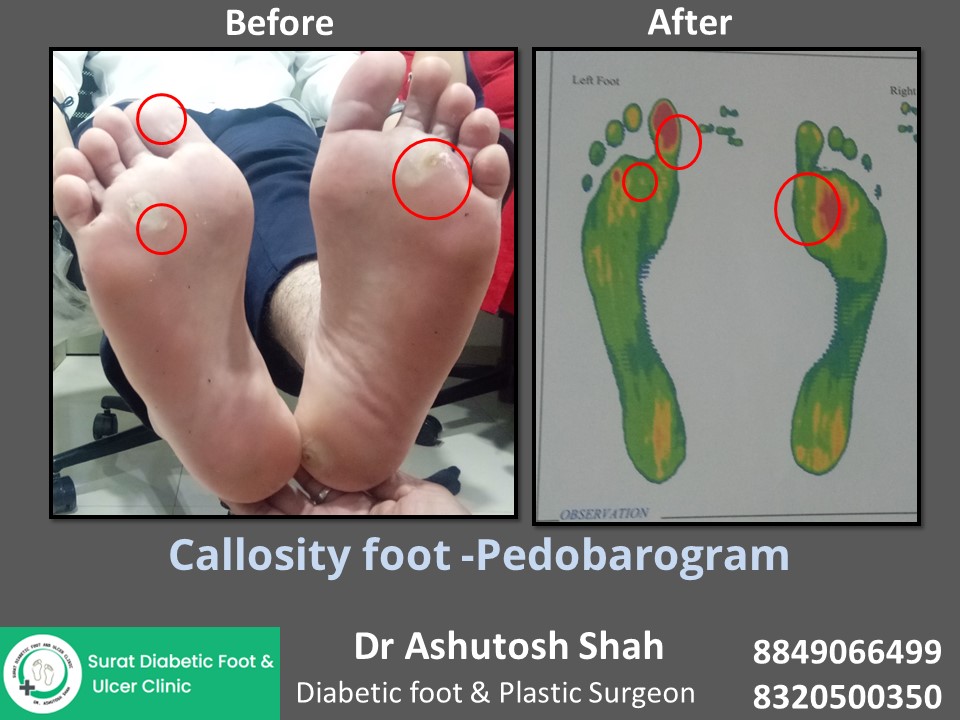 Diabetic Foot Ulcer Prevention, Foot Treatment, Infected oot,